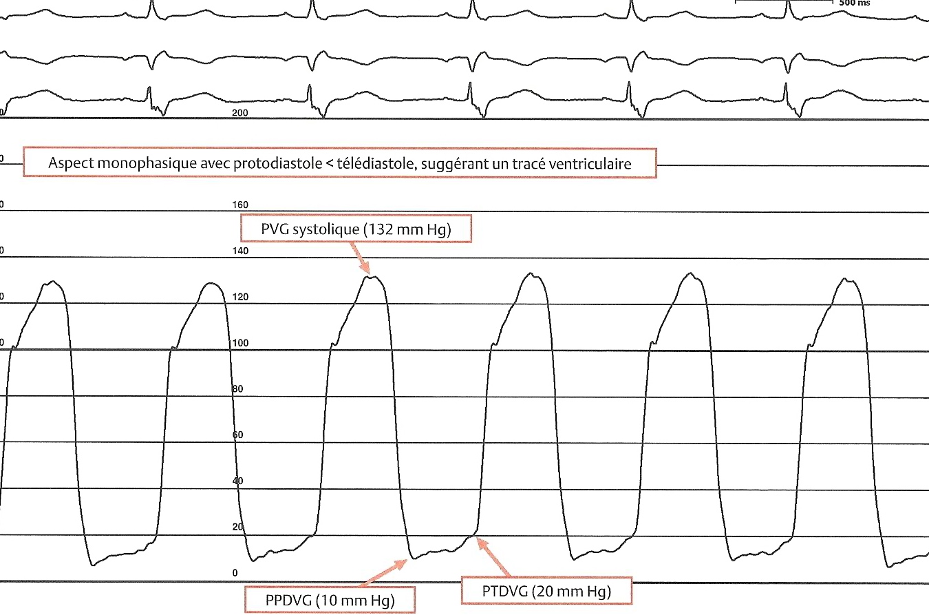 La Ventriculographie Gauche Cardio Paramed Cardio Paramed