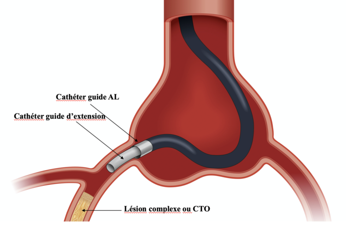 Le cathéter d'extension Cardio paramed Cardio paramed